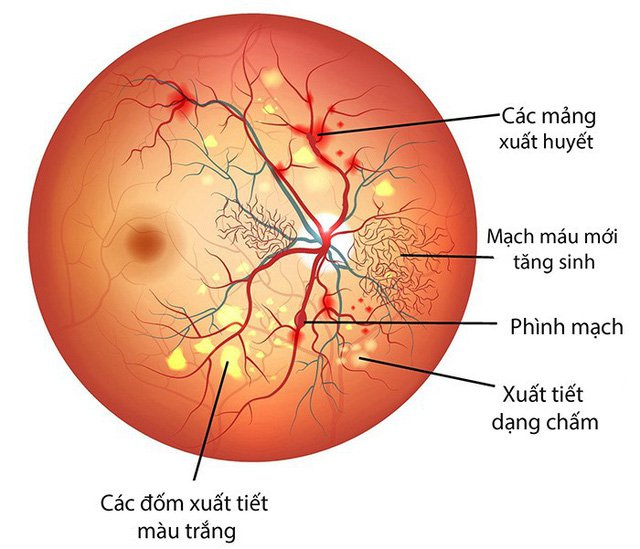 Bệnh võng mạc mắt