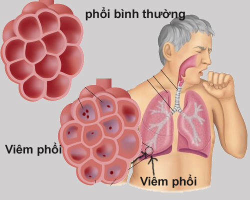 Người bệnh tiểu đường sẽ dễ mắc viêm phổi hơn bình thường.