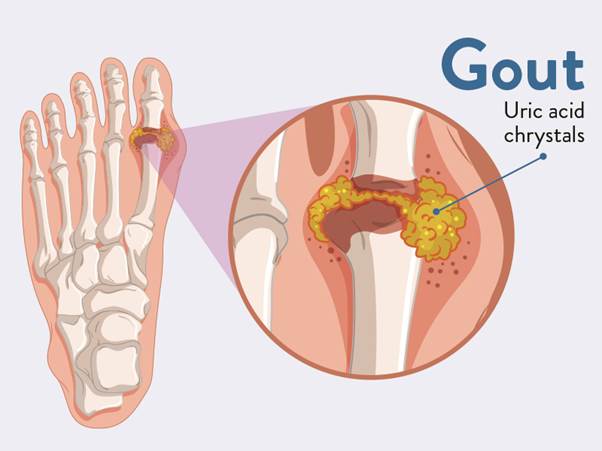 Bệnh gút nguy hiểm như thế nào? Giải pháp nào là tốt nhất?