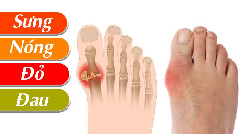 Bệnh Gout gây đau ở các khớp chi dưới