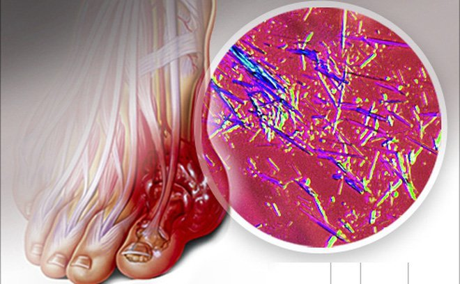 Acid uric tăng cao sẽ khiến cơn gút cấp bùng phát