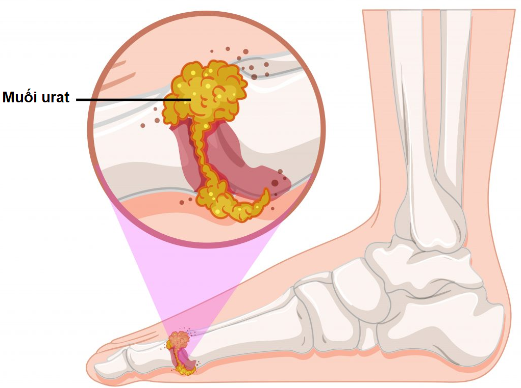  Muối urat lắng đọng tại khớp do acid uric trong máu tăng cao