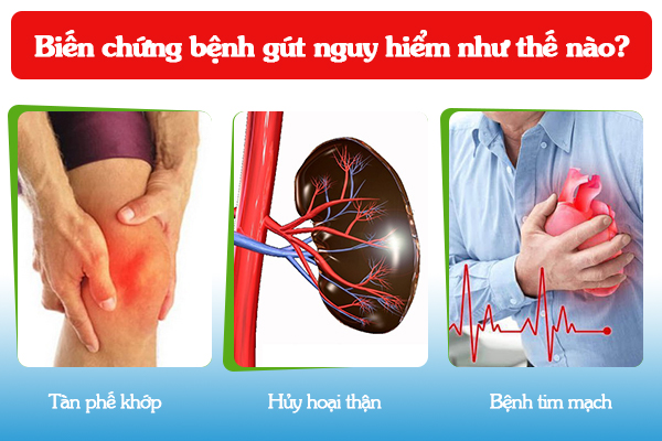 Biến chứng bệnh gút nguy hiểm như thế nào?