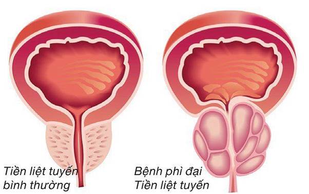 Phì đại tiền liệt tuyến là nguyên nhân hàng đầu gây tiểu rắt ở nam giới trung và cao niên