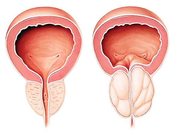 Tuyến tiền liệt bị phì đại chèn ép lên ống niệu đạo