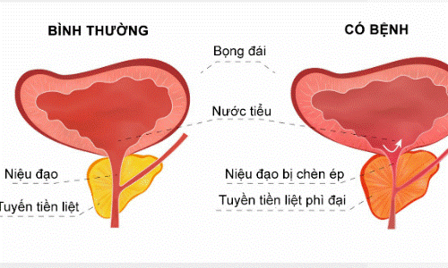 Tìm hiểu về các thuốc u xơ tuyến tiền liệt