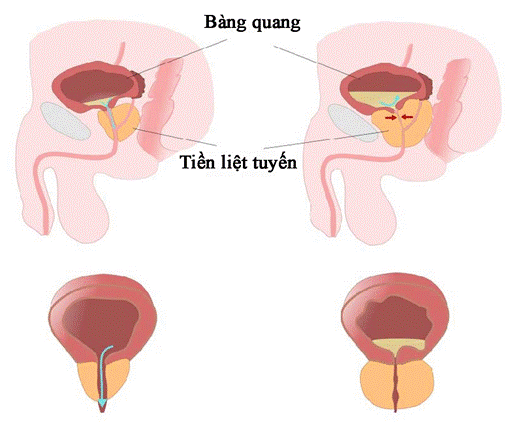 U xơ tiền liệt tuyến có mấy giai đoạn?