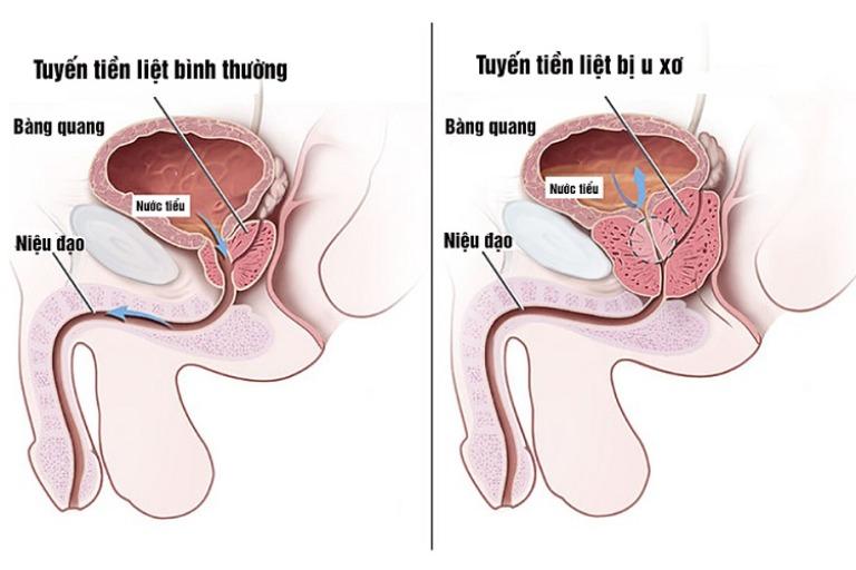 U xơ tuyến tiền liệt là gì?