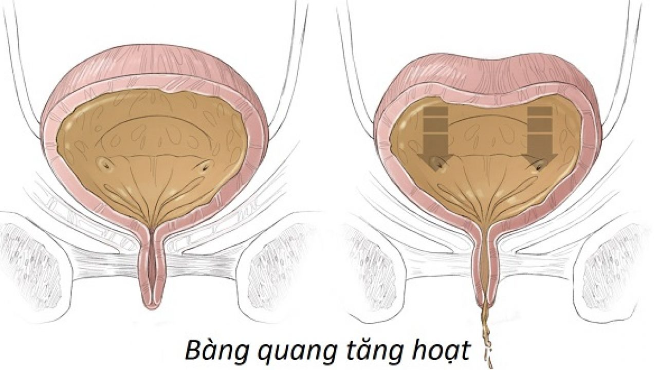 Bàng quang tăng hoạt gây tiểu nhiều lần