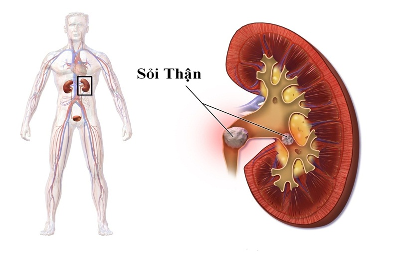 Sỏi thận cũng là nguyên nhân gây ra tình trạng tiểu rắt