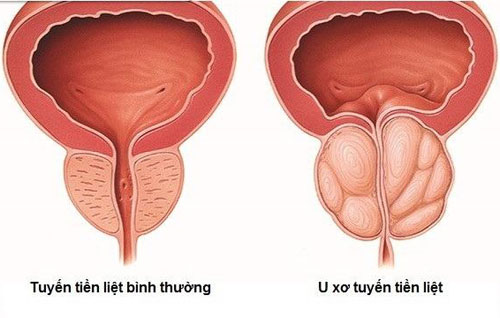 U xơ tuyến tiền liệt gây tình trạng tiểu rắt