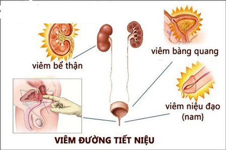 Viêm đường tiết niệu gây ra hiện tượng tiểu rắt