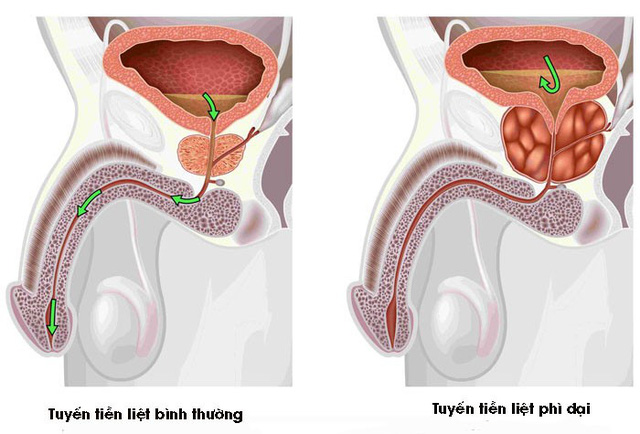 Các cách chữa u xơ tuyến tiền liệt phổ biến