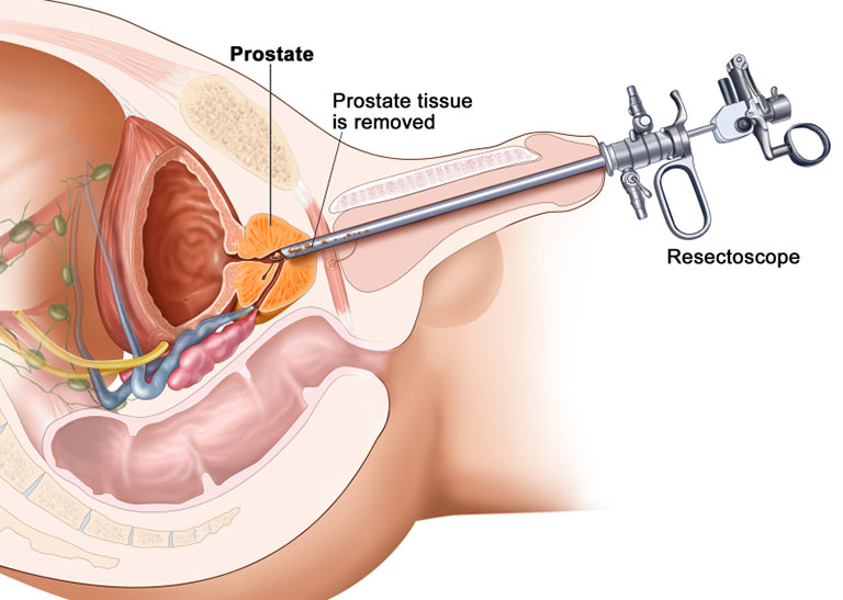 Phẫu thuật u xơ tuyến tiền liệt gây ra nhiều rủi ro và tốn kém