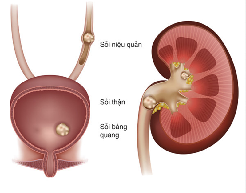 U xơ tuyến tiền liệt có nguy hiểm không? Giải pháp khắc phục an toàn và hiệu quả nhất