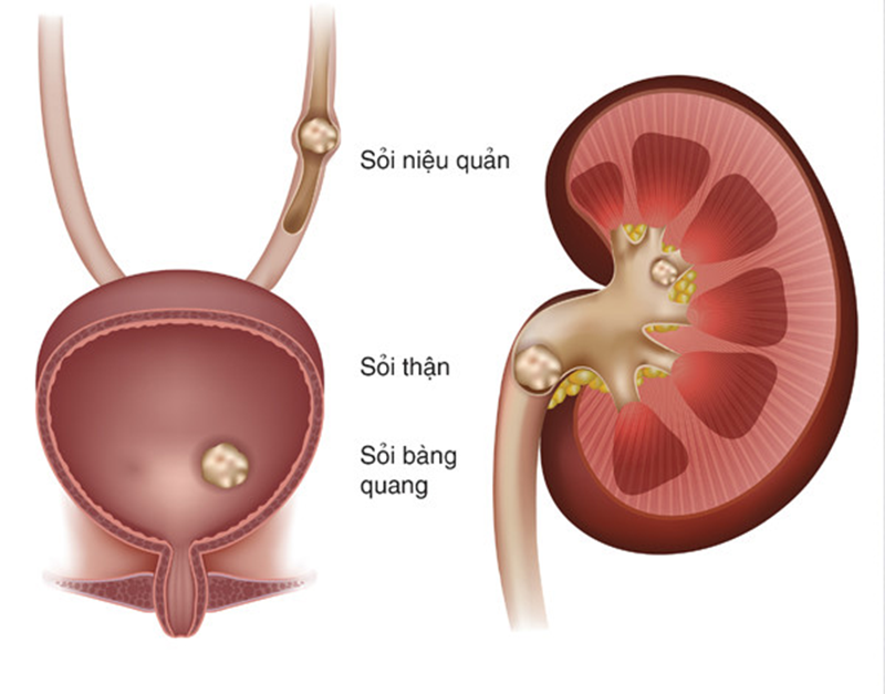 Biến chứng sỏi tiết niệu