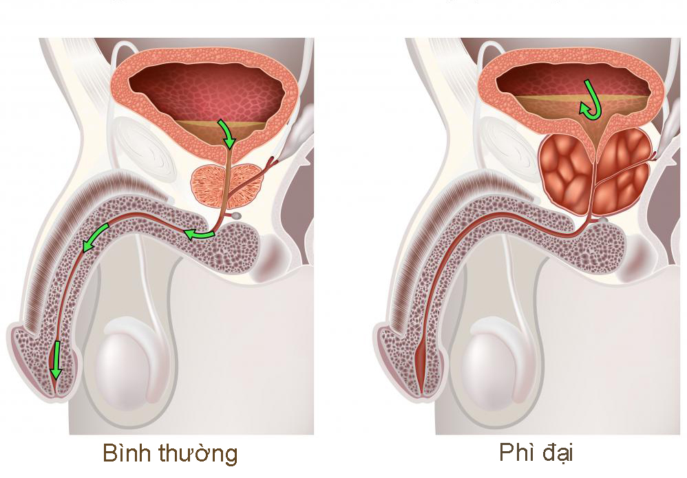 Phì đại tuyến tiền liệt kiêng ăn gì?