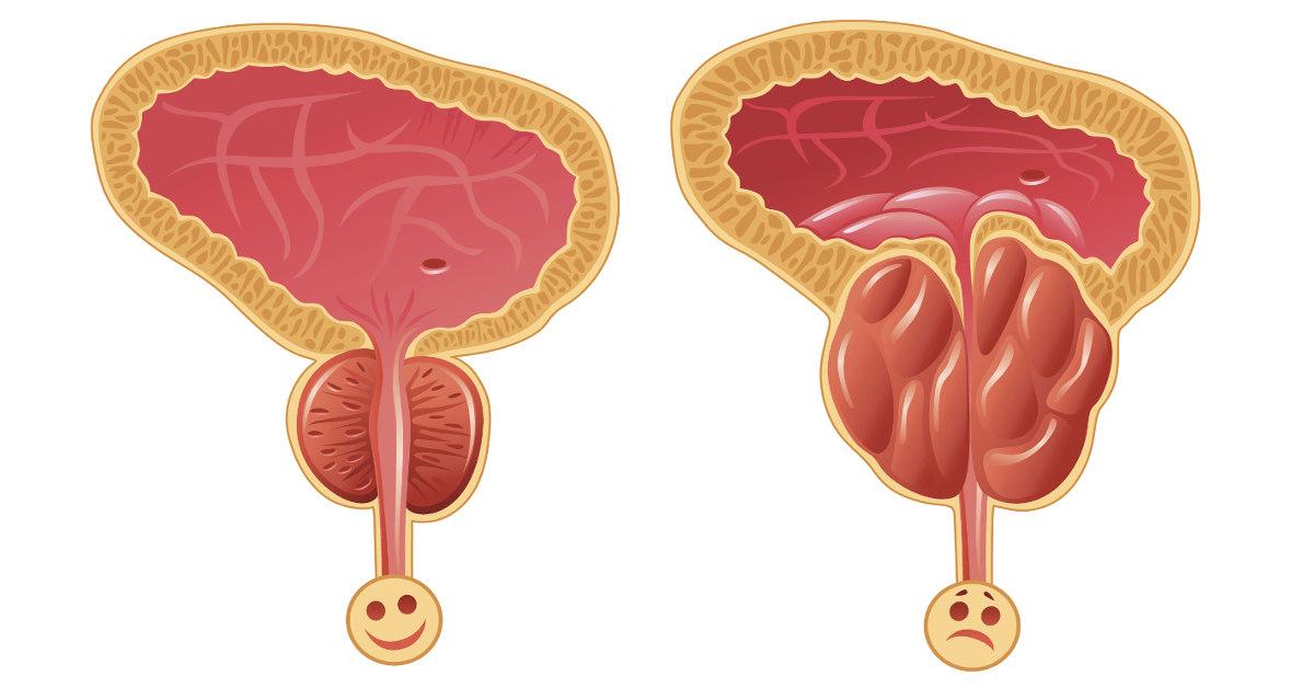 Phì đại tuyến tiền liệt là nguyên nhân hàng đầu gây bí tiểu