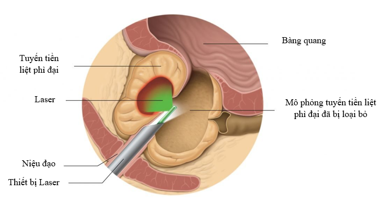 Phương pháp điều trị phì đại tuyến tiền liệt bằng laser