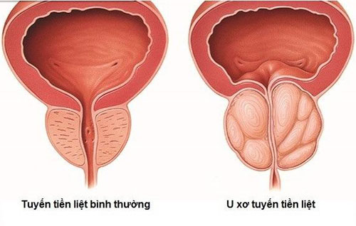 Phì đại tuyến tiền liệt là nguyên nhân hàng đầu gây tình trạng tiểu rắt