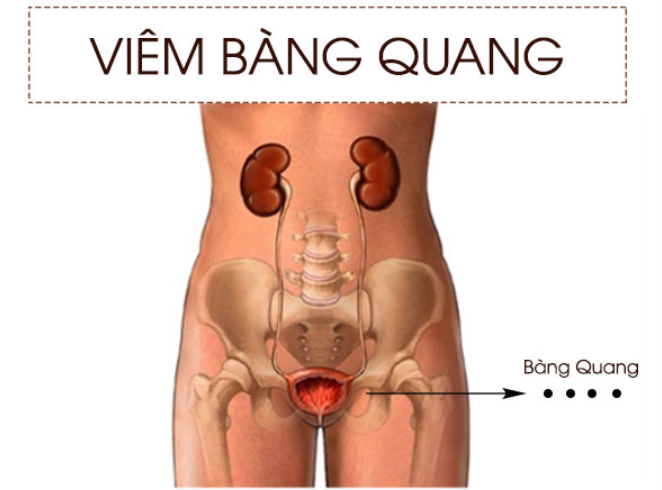 Viêm bàng quang gây ra tình trạng tiểu rắt ở nam giới