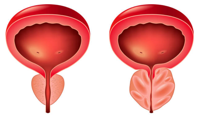 Phì đại tuyến tiền liệt là nguyên nhân hàng đầu gây tiểu đêm nhiều lần ở nam giới