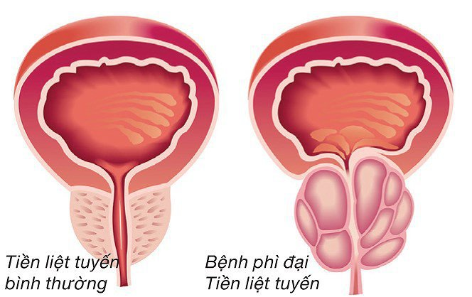 Hạt bí đỏ có tác dụng giúp cải thiện phì đại tuyến tiền liệt