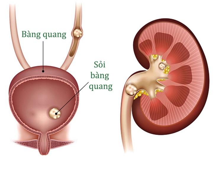 U xơ tiền liệt tuyến có thể dẫn đến sỏi thận, sỏi bàng quang