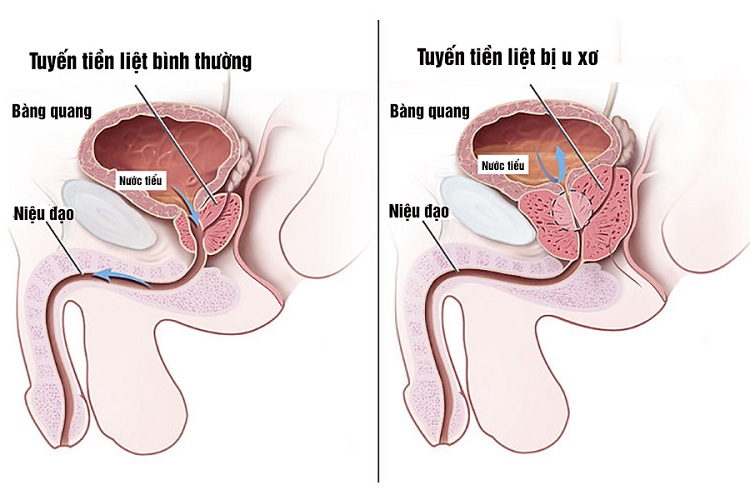  Phì đại tuyến tiền liệt gây ứ đọng nước tiểu khiến viêm đường tiết niệu  tái phát thường xuyên