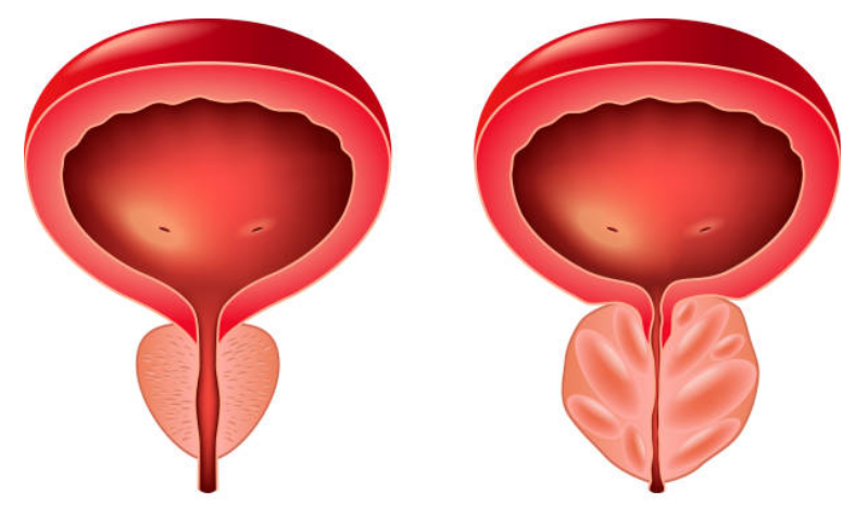 Tiểu đêm nhiều lần ở nam giới do phì đại tuyến tiền liệt