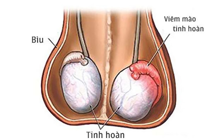 Viêm tuyến tiền liệt có thể dẫn đến viêm mào tinh hoàn