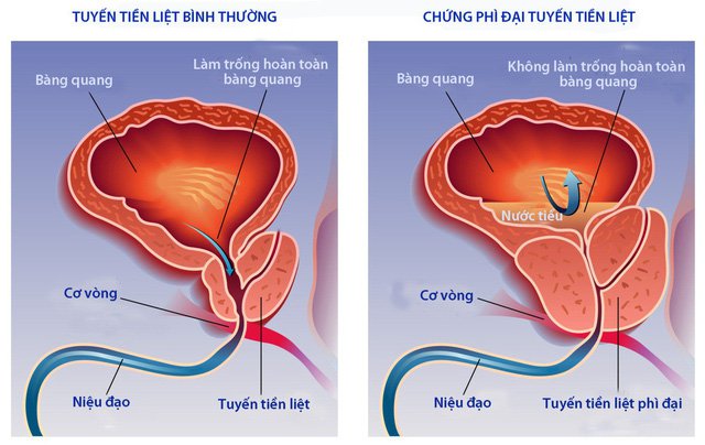 Phì đại tuyến tiền liệt chèn ép vào niệu đạo và bàng quang