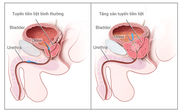 Tiểu không hết khiến nước tiểu bị đọng lại trong bàng quang