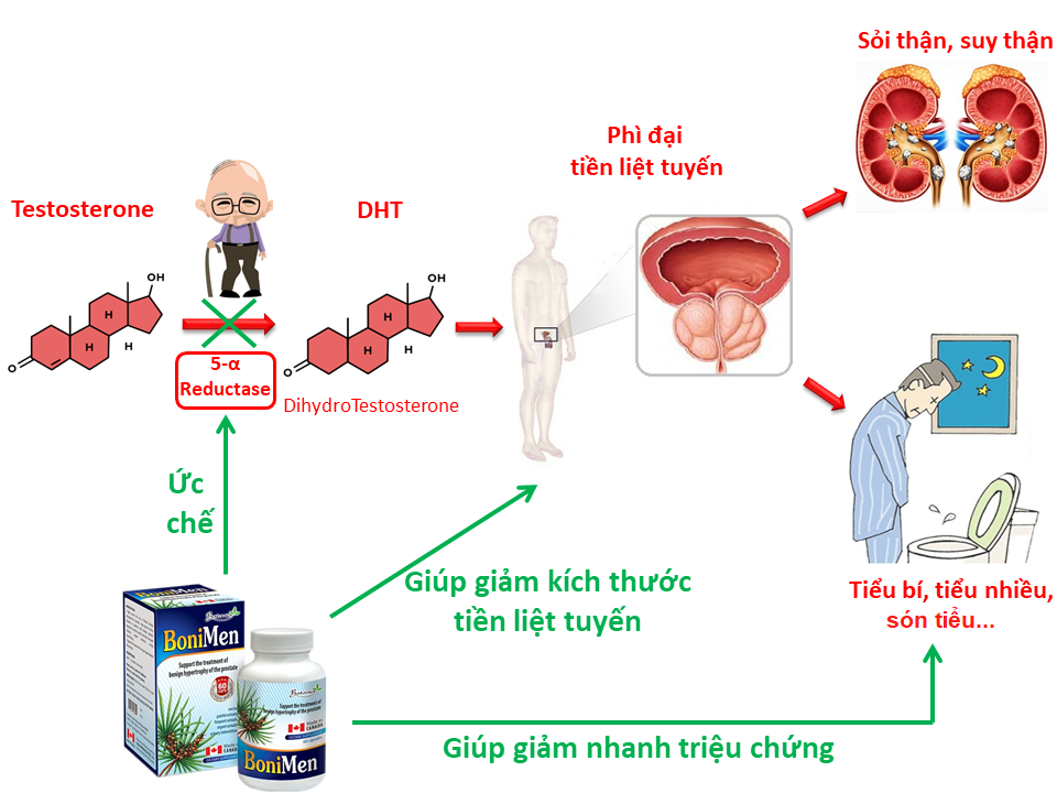 BoniMen giúp cải thiện toàn diện bệnh phì đại tuyến tiền liệt