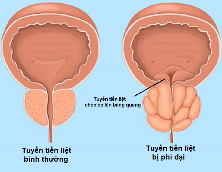 Kích thước tuyến tiền liệt tăng lên gây chèn ép và kích thích bàng quang