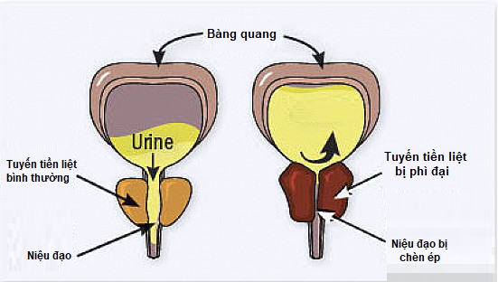 Tuyến tiền liệt chèn ép niệu đạo khiến nước tiểu ứ lại trong bàng quang