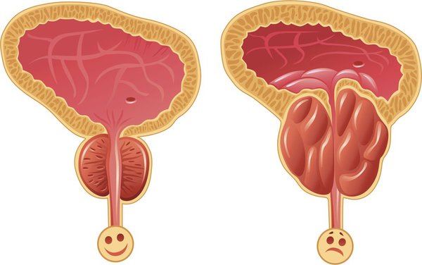 Kích thước tuyến tiền liệt bình thường và khi bị phì đại