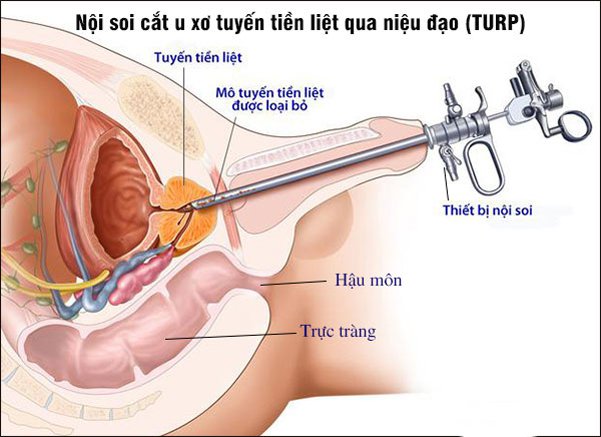 Nội soi cắt u xơ tiền liệt tuyến qua niệu đạo được chỉ định khi kích thước dưới 80g