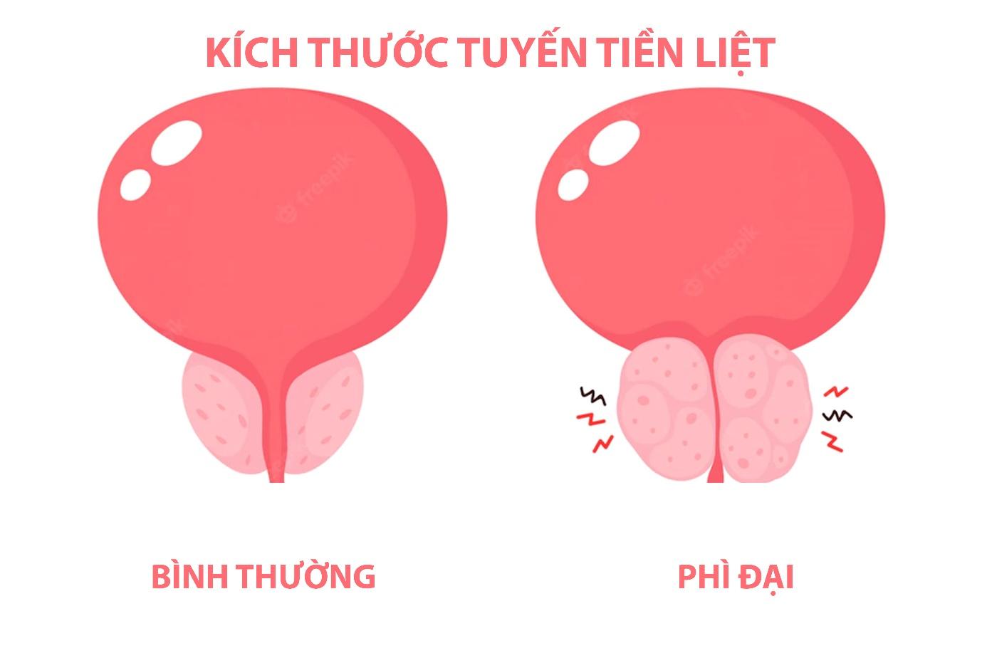 Tổng hợp những câu hỏi thường gặp về kích thước tuyến tiền liệt