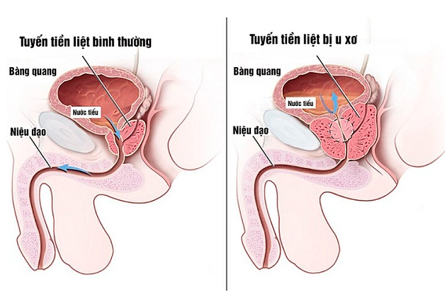 Tuyến tiền liệt bị phì đại