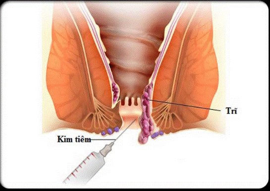 Thủ thuật chích xơ chữa bệnh trĩ cấp độ 2