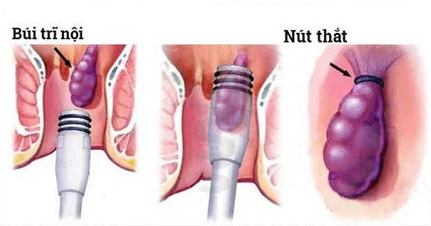 Thủ thuật thắt búi trĩ bằng vòng cao su chữa bệnh trĩ cấp độ 2