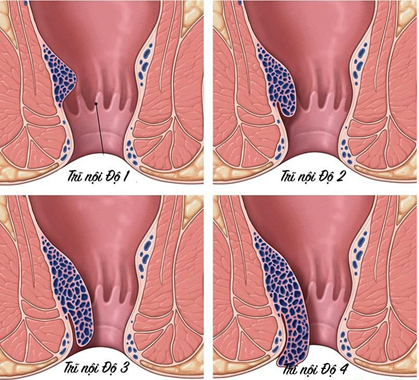 4 giai đoạn của bệnh trĩ nội