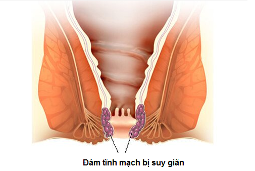 Búi trĩ thực chất là những đám tĩnh mạch bị suy giãn và sa ra