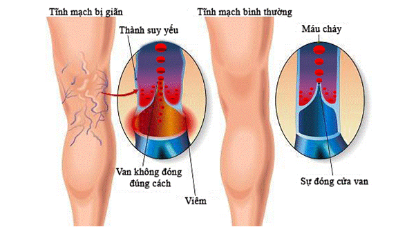 Khi các van tĩnh mạch không được đóng kín, máu không còn chảy theo 1 chiều gây ứ máu