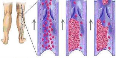 Huyết khối là biến chứng nguy hiểm nhất của suy giãn tĩnh mạch
