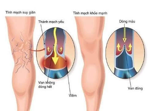 Cơ chế suy giãn tĩnh mạch