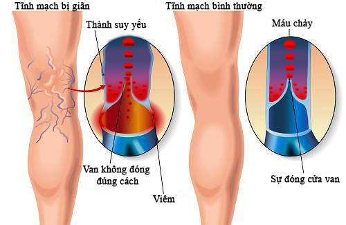 Suy giãn tĩnh mạch là bệnh gì?