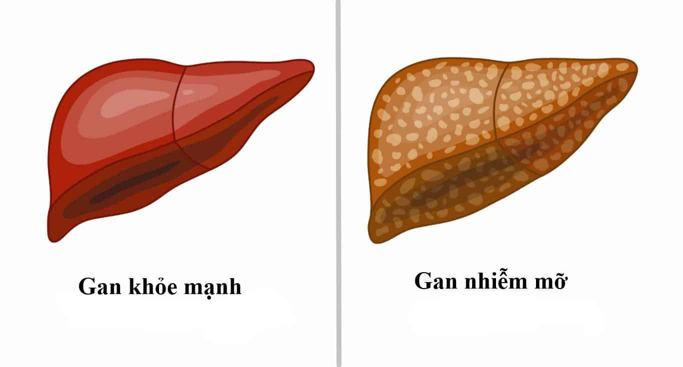 Rượu bia là nguyên nhân chính gây ra tình trạng gan nhiễm mỡ