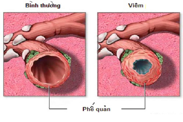 Bệnh viêm phế quản mãn tính có nguy hiểm không?